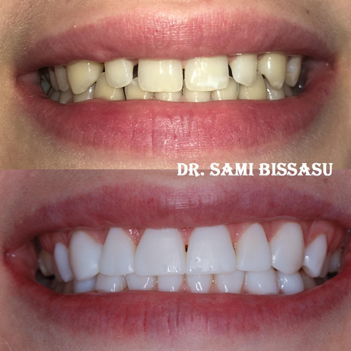Before After