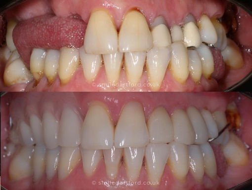 Before After